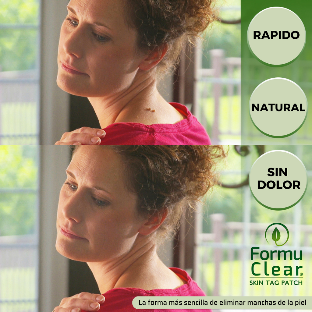 Parches para eliminar verrugas sin dolor